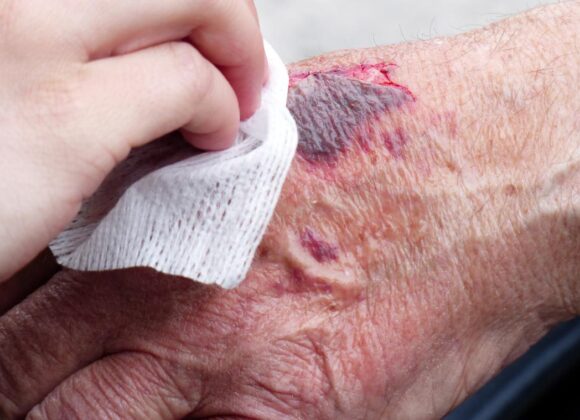 WOUND CARE